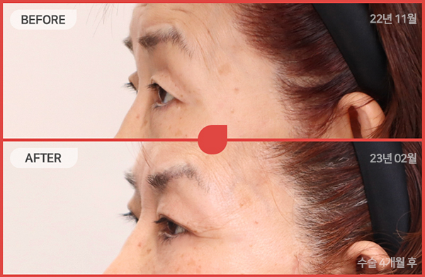 ด้านข้างของใบหน้า