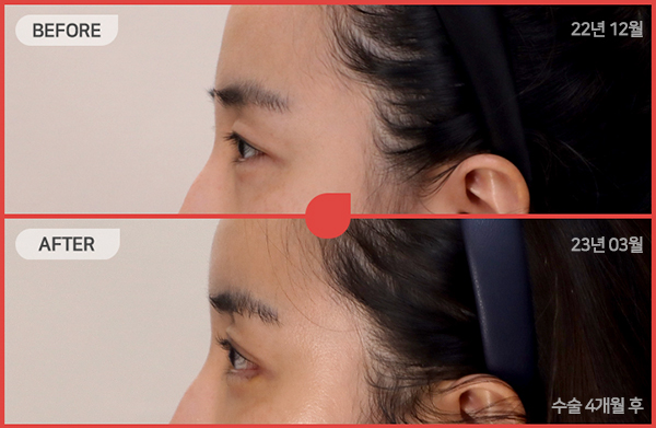 ด้านข้างของใบหน้า