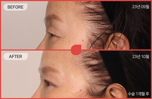 ด้านข้างของใบหน้า