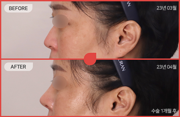 ด้านข้างของใบหน้า