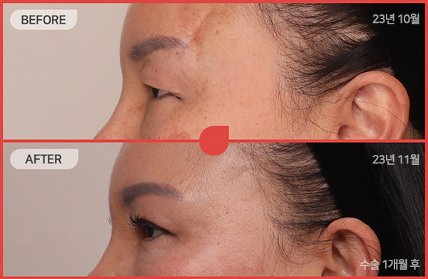 ด้านข้างของใบหน้า