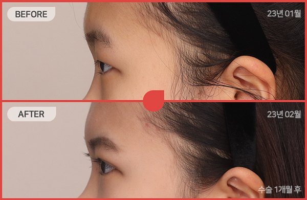 ด้านข้างของใบหน้า