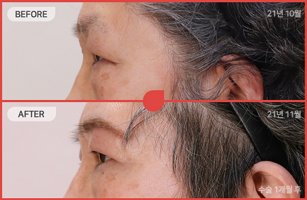 ด้านข้างของใบหน้า