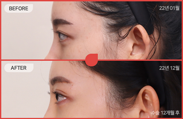 ด้านข้างของใบหน้า