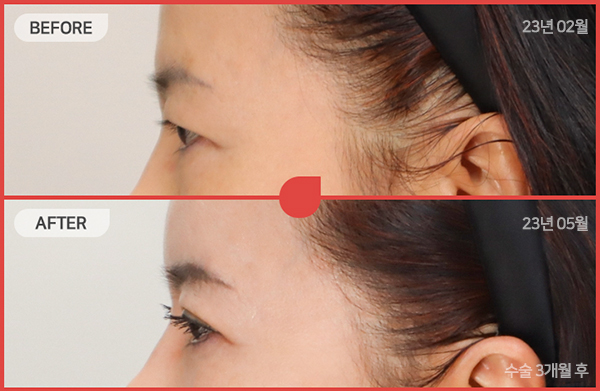 ด้านข้างของใบหน้า