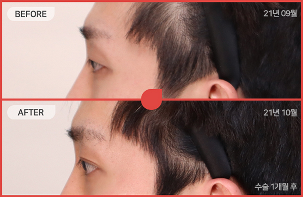 ด้านข้างของใบหน้า