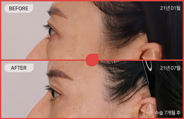 ด้านข้างของใบหน้า