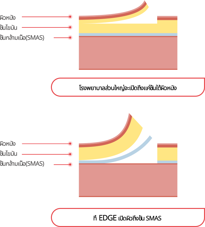 mini_incisio_img04_m