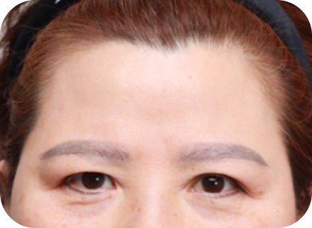 forehead_lift img