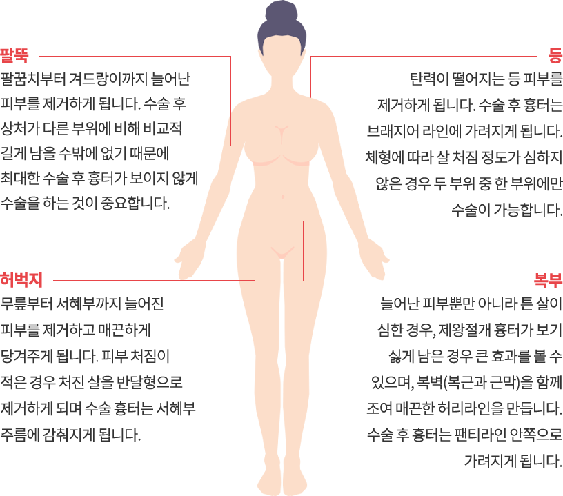 body_lift model img