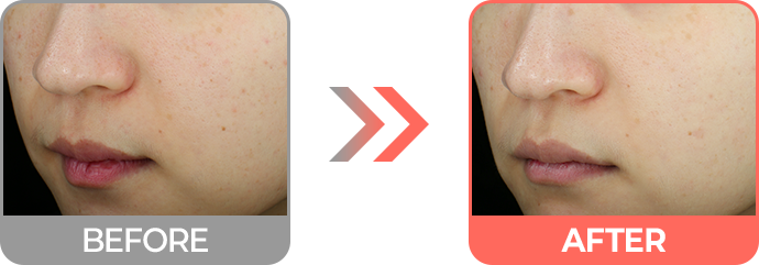 리투오 효과 홍조 감소