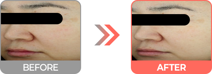 리투오 효과 홍조 감소