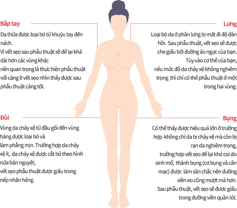 body_lift model img