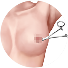 mastopexy_img01
