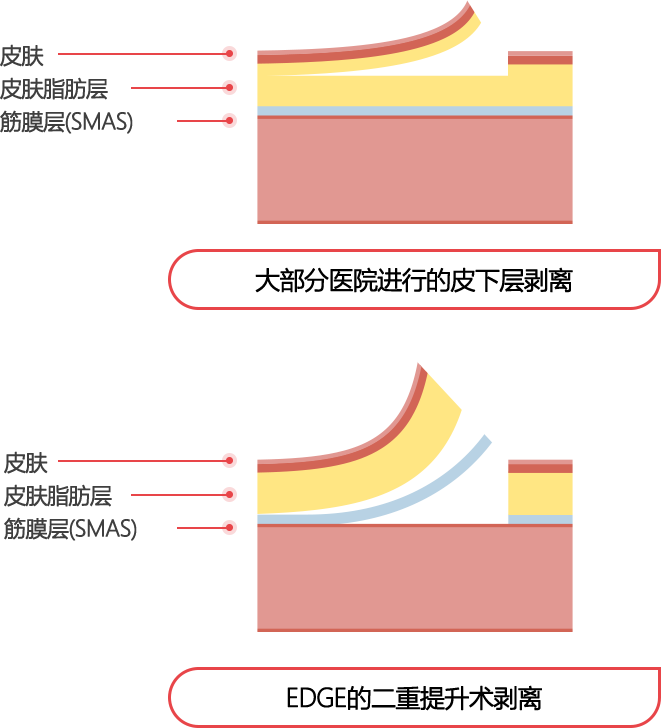 mini_incisio_img04_m