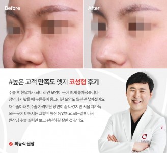 엣지성형외과&피부과 코성형 후기