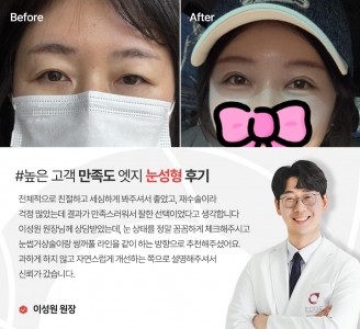 엣지성형외과&피부과 눈성형 후기