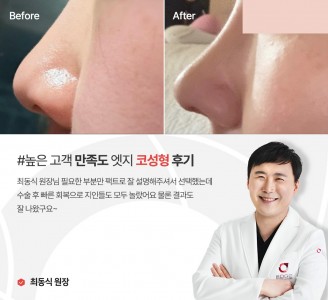 엣지성형외과&피부과 코성형 후기