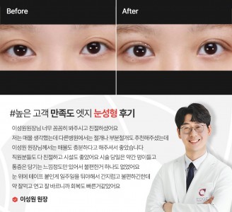 엣지성형외과&피부과 눈성형 후기