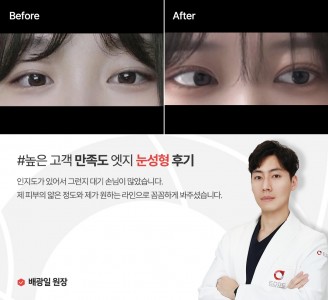 엣지성형외과&피부과 눈성형 후기
