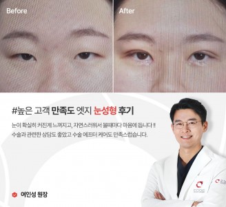 엣지성형외과&피부과 눈성형 후기