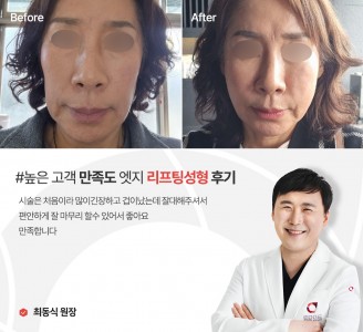 엣지성형외과&피부과 리프팅성형 후기