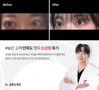 엣지성형외과&피부과 눈성형 후기