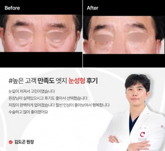 엣지성형외과&피부과 눈성형 후기