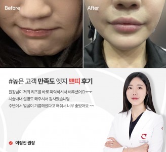 엣지성형외과&피부과 쁘띠 후기