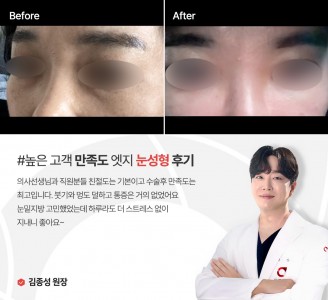 엣지성형외과&피부과 눈성형 후기