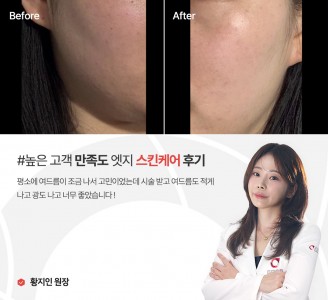 엣지성형외과&피부과 스킨케어 후기