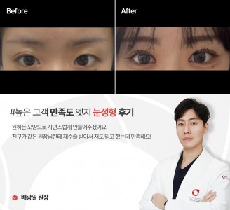 엣지성형외과&피부과 눈성형 후기