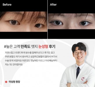 엣지성형외과&피부과 눈성형 후기
