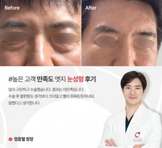 엣지성형외과&피부과 눈성형 후기
