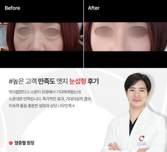 엣지성형외과&피부과 눈성형 후기