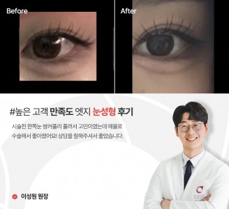 엣지성형외과&피부과 눈성형 후기