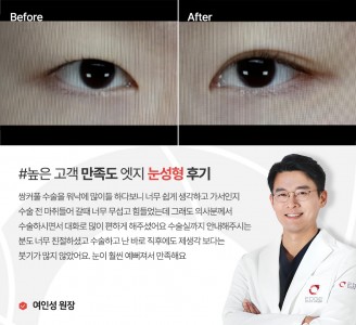 엣지성형외과&피부과 눈성형 후기