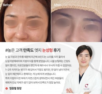 엣지성형외과&피부과 눈성형 후기